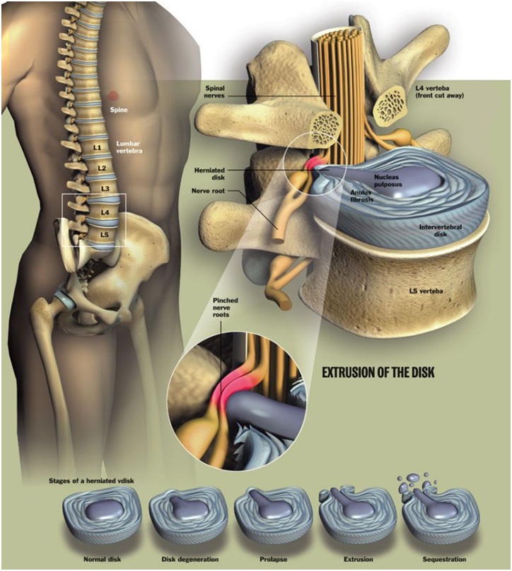 Lumbar Disc Bulge vs. Lumbar Disc Herniation vs. Lumbar Disc Extrusion vs. Low Back Degenerative Disc Disease (DDD)